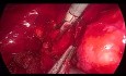 Exploración Laparoscópica del Conducto Biliar Común. Hemorragia de la Arteria Supraduodenal