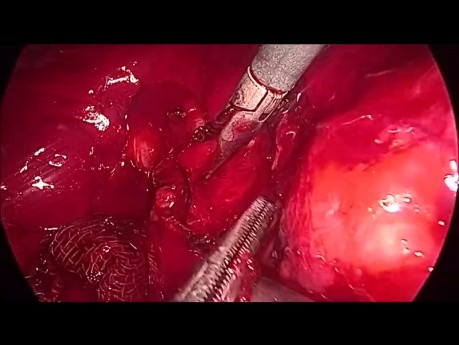 Exploración Laparoscópica del Conducto Biliar Común. Hemorragia de la Arteria Supraduodenal