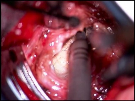 Fusión ventral con PEEK 