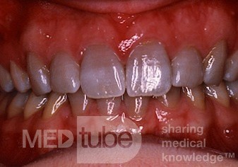 Tinción de los dientes con tetraciclina