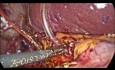 Cálculos del conducto biliar común - Tratamiento laparoscópico