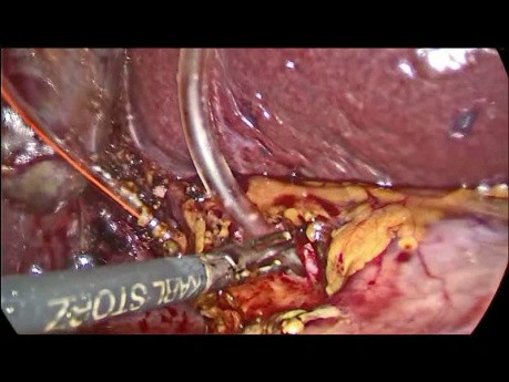 Cálculos del conducto biliar común - Tratamiento laparoscópico
