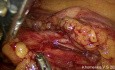 Tratamiento quirúrgico avanzado del cáncer de colon sigmoide