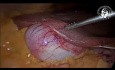 Tejido hepático aberrante en la superficie de la vesícula biliar