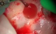 Apicectomía (amputación de la raíz) con láser bajo lupa