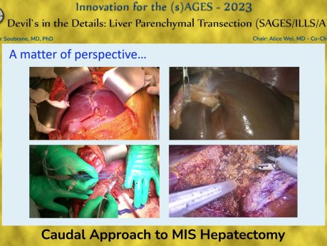 Abordaje caudal para la Hepatectomía mínimamente invasiva (MIS)