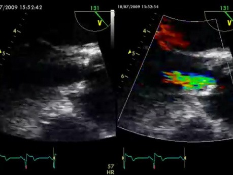 Una membrana fibrosa debajo de la válvula aórtica: un caso de membrana subaórtica