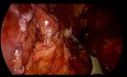 Pancreatectomía distal laparoscópica con preservación del bazo para sangrado de la vena esplénica