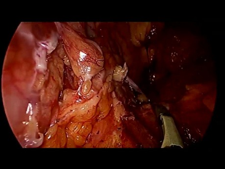 Pancreatectomía distal laparoscópica con preservación del bazo para sangrado de la vena esplénica