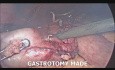 Cirugía bariátrica revisional laparoscópica (gastrectomía en manga "sleeve" a OAGB)