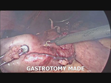 Cirugía bariátrica revisional laparoscópica (gastrectomía en manga "sleeve" a OAGB)