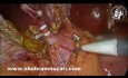 Esfanterotomía anterógrada con dilatación con catéter durante la exploración laparoscópica del conducto biliar común