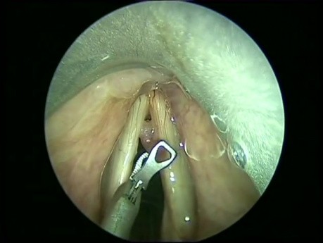 Evaluación intraoperatoria: pólipo de las cuerdas vocales, parte I