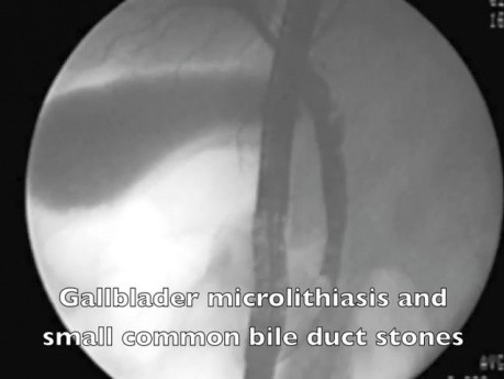 Pancreatitis - tratamiento endoscópico