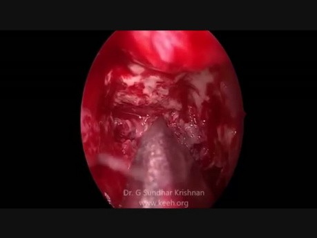 Aspergilosis rinoórbitocerebral