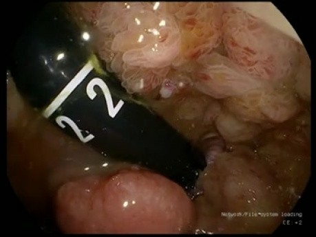 DSE de pólipo rectal circunferencial - resección endoscópica total de la mucosa rectal