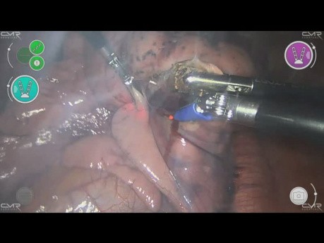 Metastasectomía pulmonar robótica con Versius Robotic system