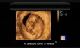 Ultrasonido 4D - Feto normal de 11 semanas