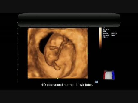 Ultrasonido 4D - Feto normal de 11 semanas
