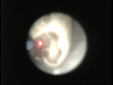Litotricia láser ureteroscópica