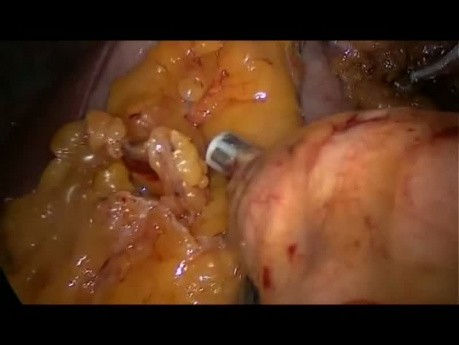 Pancreatectomía izquierda laparoscópica