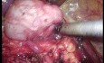 Estenosis pieloureteral izquierda. Pieloplastia laparoscópica.