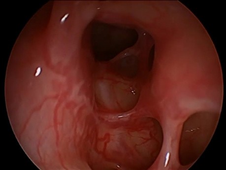 Cirugía endoscópica funcional de los senos paranasales (FESS): Aspecto de la cavidad nasal después de la endoscopia.