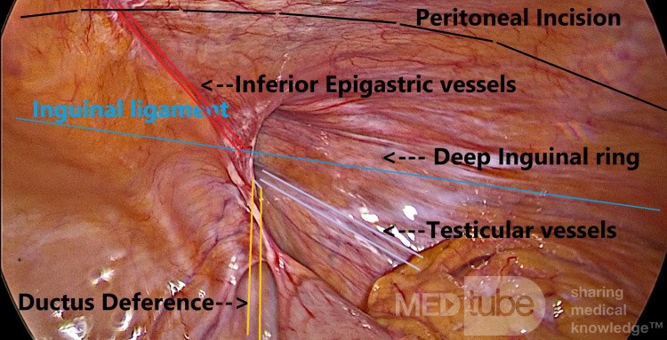 Hitos en la exploración laparoscópica de hernias TAPP