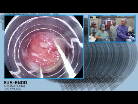 Nuevo EGD con mapeo y resección del carcinoma in situ