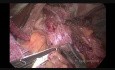 Miotomía laparoscópica de Heller con fundoplicatura de Dor para acalasia