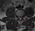 Microdiscectomía Lumbar