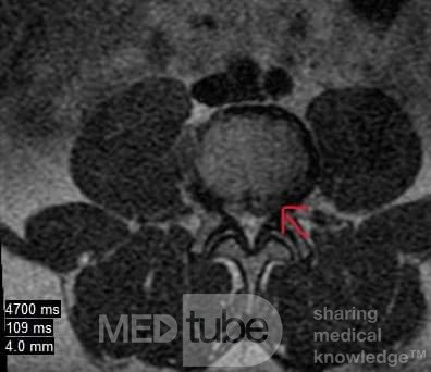 Microdiscectomía Lumbar