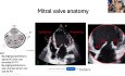 Basics of Mitral Valve Anatomy and Pre-procedural Imaging for Mitral TEER