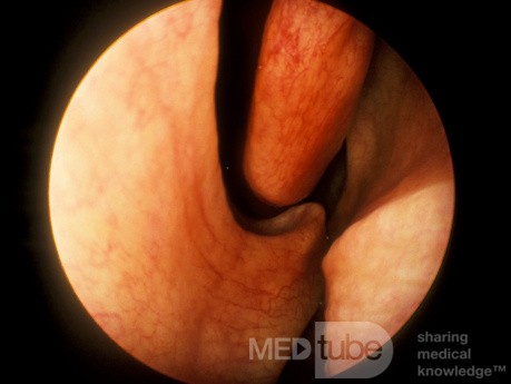 Espolón septal nasal