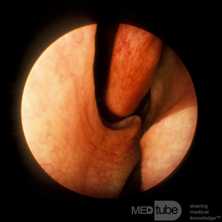 Espolón septal nasal