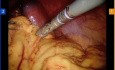 Pancreatectomía y esplenectomía distal robótica
