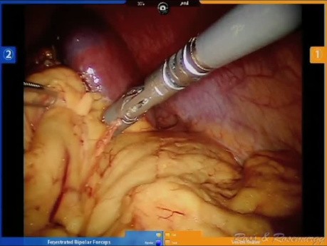 Pancreatectomía y esplenectomía distal robótica