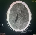 Craniectomía descompresiva en infarto maligno de la arteria cerebral media
