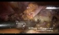 Histerectomía total después de tres cesáreas