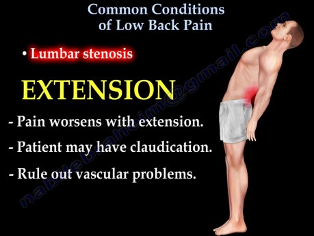 Causas comunes del dolor lumbar