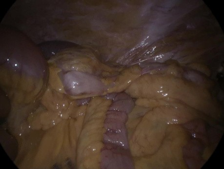 Hernia interna después de cirugía colorrectal laparoscópica
