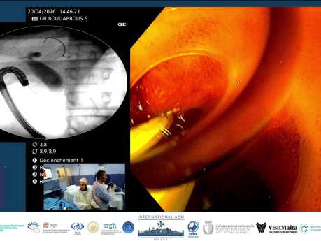 Cuando la puerta está cerrada con llave, busque otra llave. CPRE con endoscopio de visión frontal.