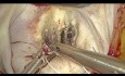 Reparación endoscópica de la válvula mitral para la rotura cordal aguda