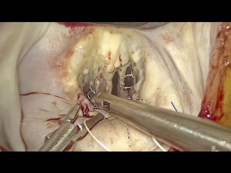 Reparación endoscópica de la válvula mitral para la rotura cordal aguda