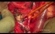 Cirugía citorreductora del cáncer de ovario. La histerectomía de Hudson.