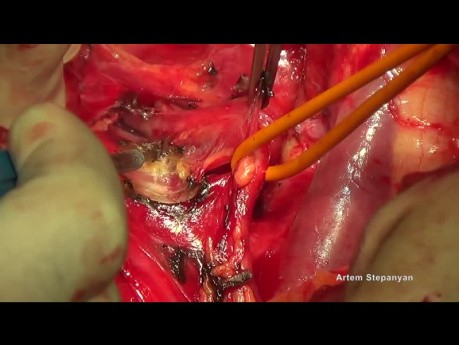 Cirugía citorreductora del cáncer de ovario. La histerectomía de Hudson.