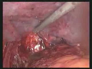 Reparación de hernia inguinal bilateral con malla quirúrgica