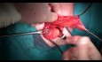 Hernia Inguinal Abierta