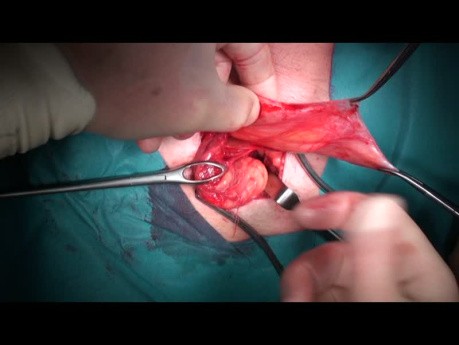 Hernia Inguinal Abierta