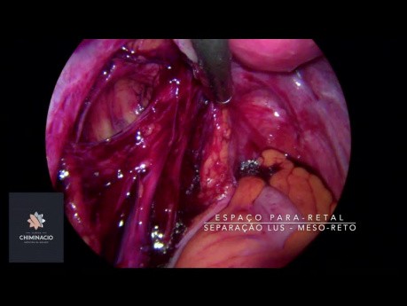 Cirugía de endometriosis e infertilidad 